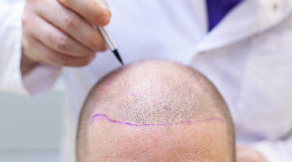 Preparing-for-Your-Hair-Transplant-in-Istanbul