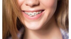 How-to-Choose-the-Right-Cosmetic-Braces-for-Your-Smile