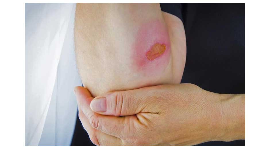 Legal-Rights-What-You-Need-to-Know-After-a-6th-Degree-Burn-Injury