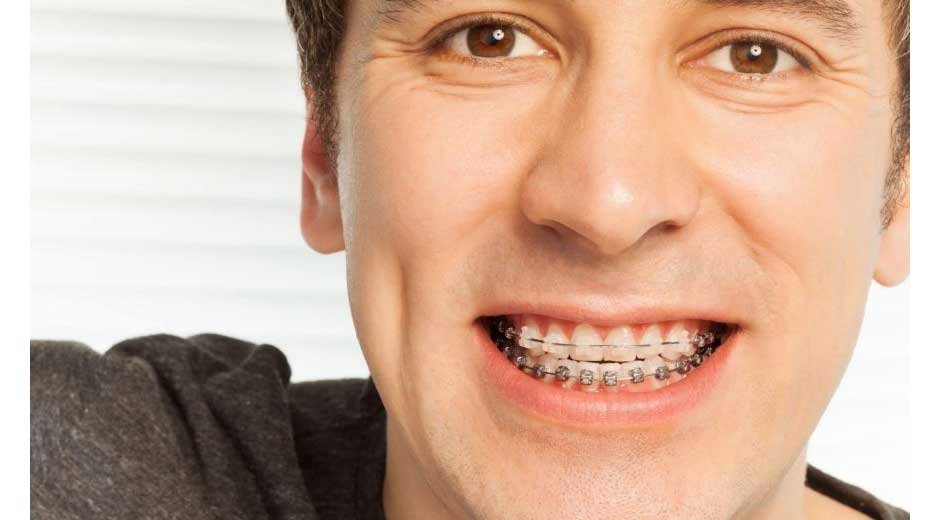 The-Benefits-of-Choosing-Smiling-Braces-for-Orthodontic-Treatment