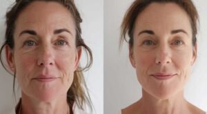 Transform Your Skin: Stunning Before and After Microneedling Results