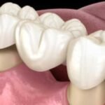 Steps Involved in Getting Dental Crowns and Bridges