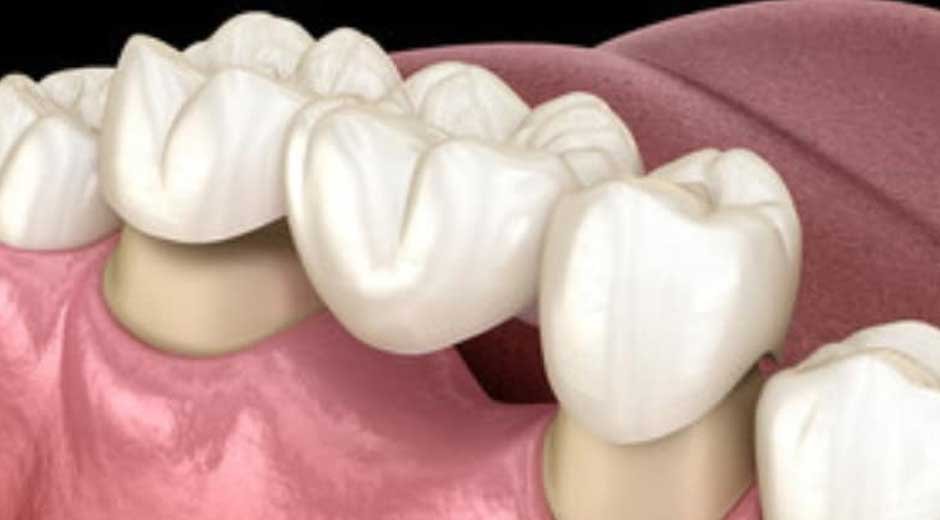 Steps Involved in Getting Dental Crowns and Bridges